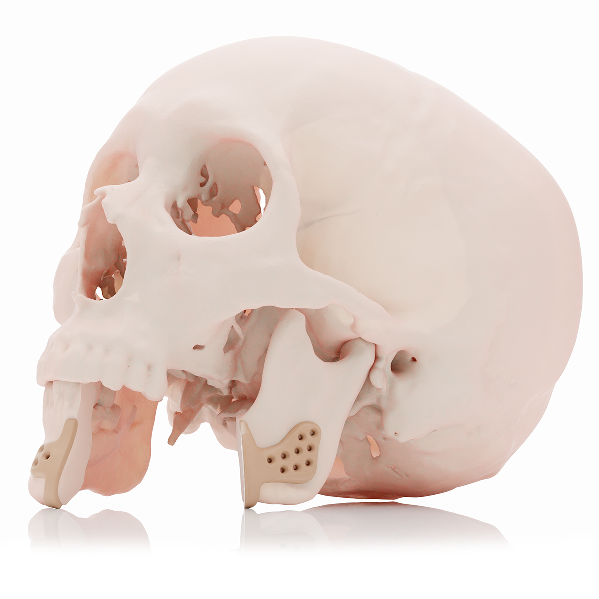 Seccion Mandibula - con Guia de corte