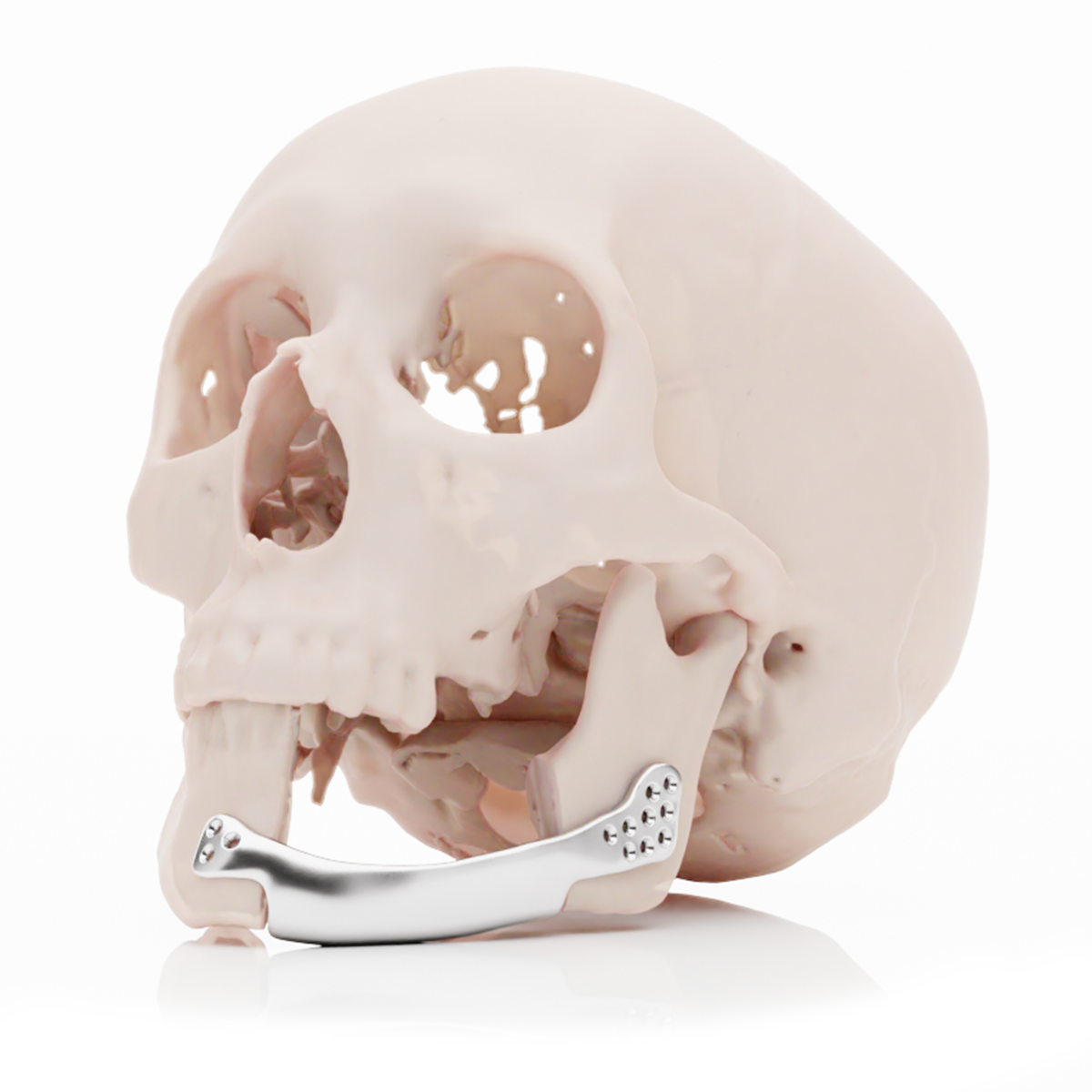 Seccion Mandibula - con titanio