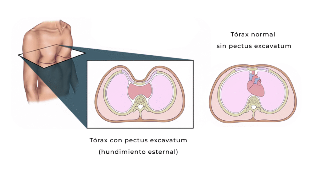 Ilustración clínica de pectus excavatum tórax con pectus y tórax sin pectus