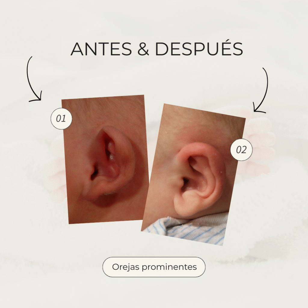 Earwell antes y después del sistema earwell