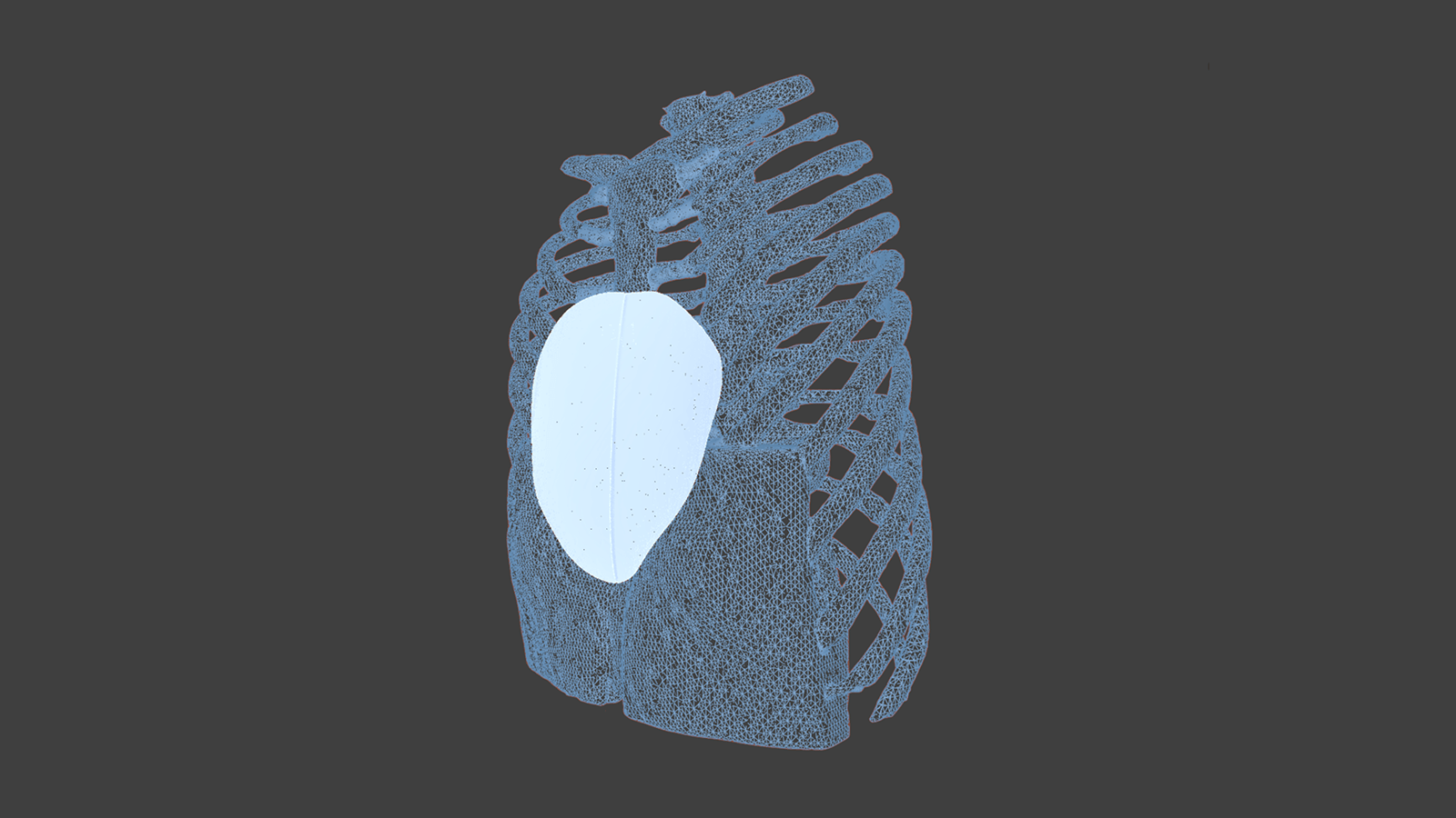 Diseño 3D implante a medida pectus excavatum toracica