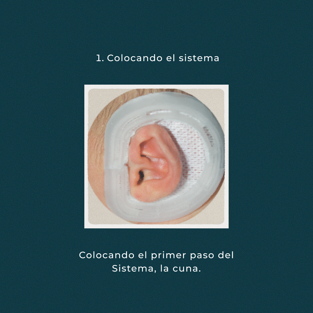 Oreja prominentes sistema earwell colocando el sistema