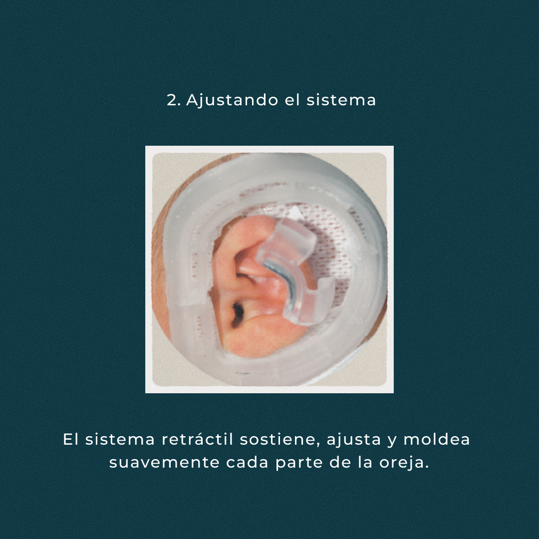 Oreja prominentes sistema earwell colocando el sistema y ajustando el sistema