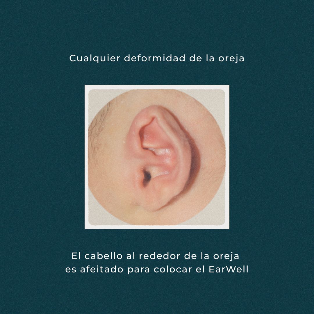 Oreja prominentes earwell paso uno
